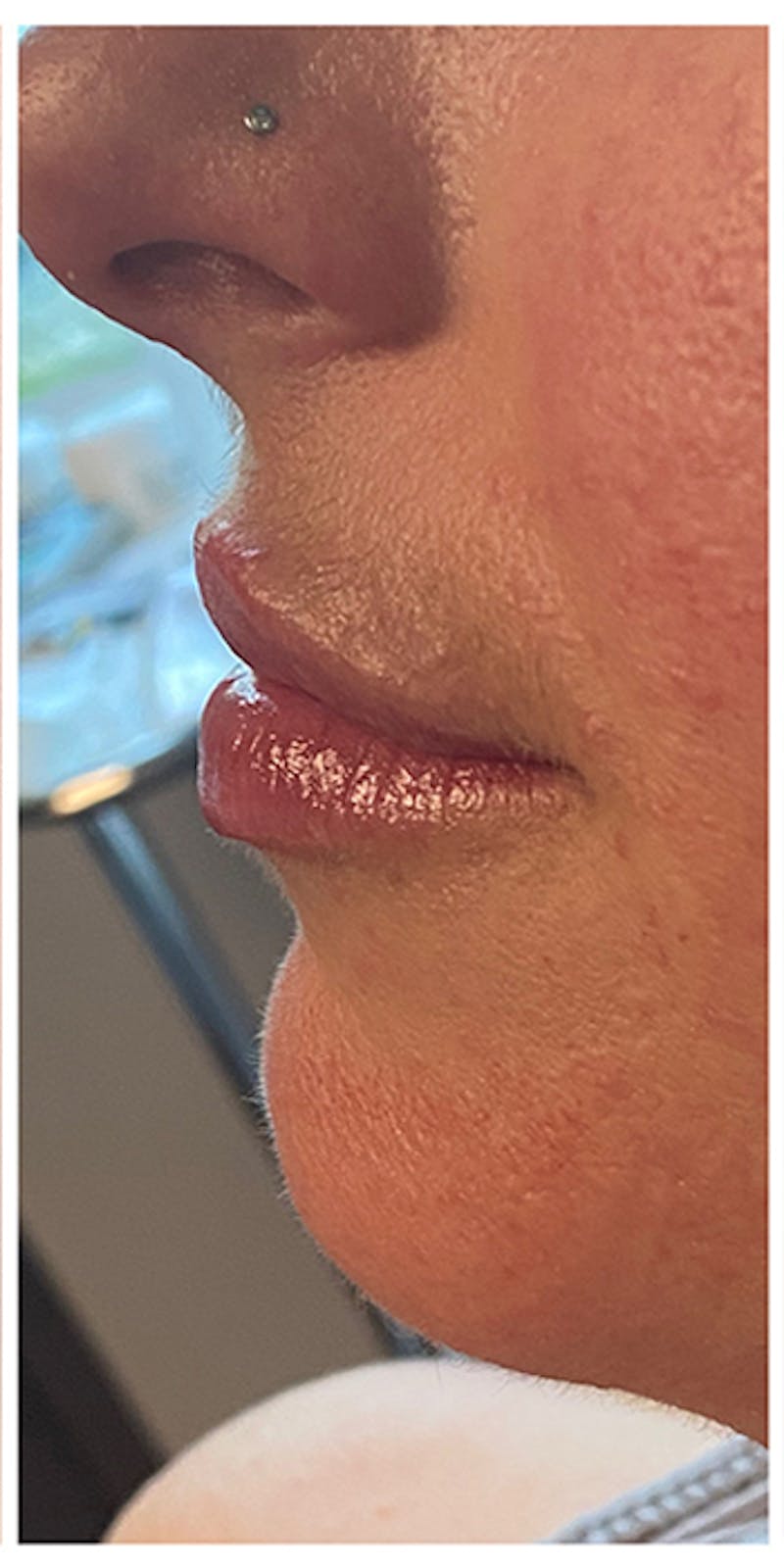 Lip Enhancement Before & After Gallery - Patient 133024141 - Image 6