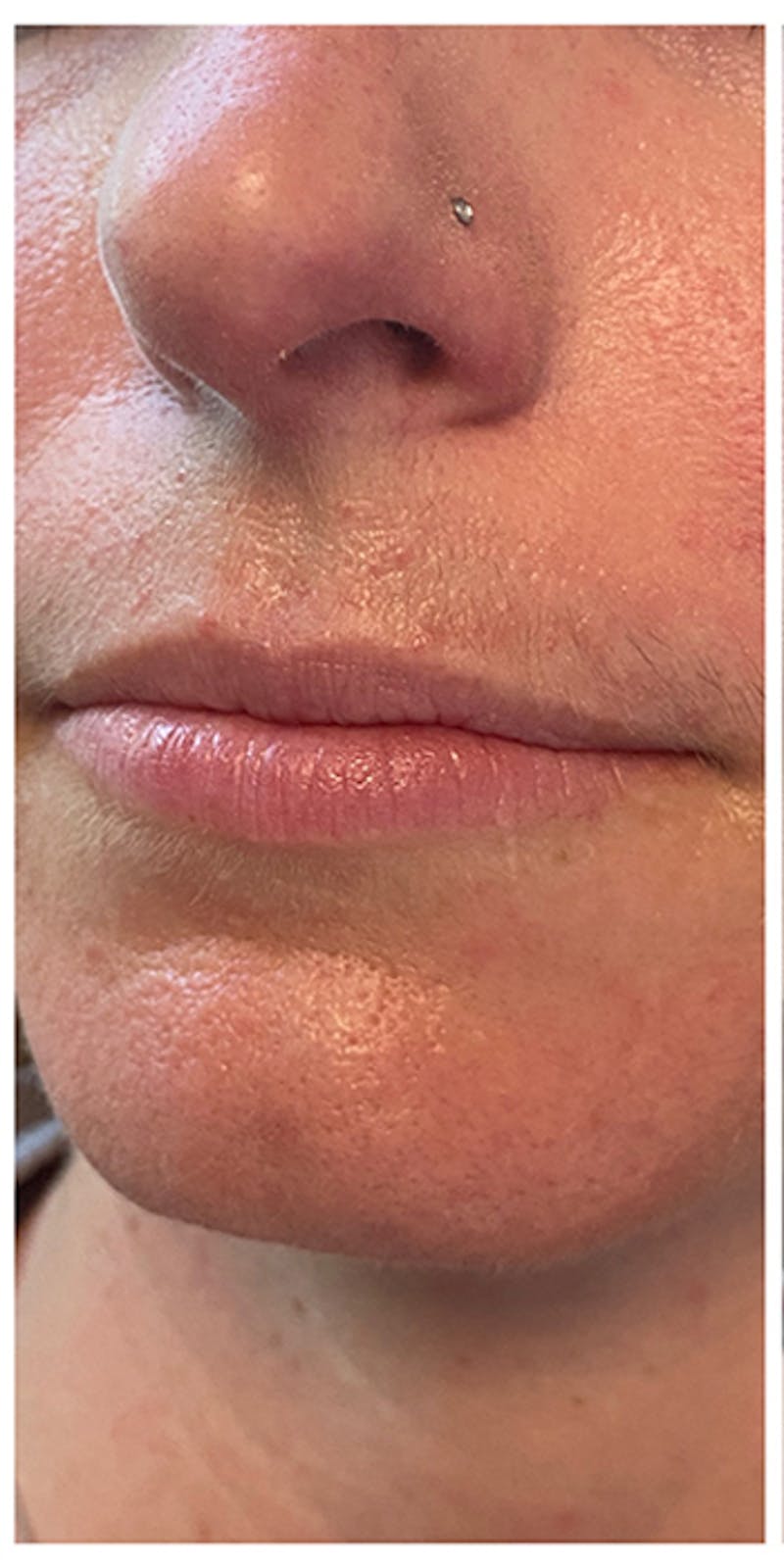 Lip Enhancement Before & After Gallery - Patient 133024141 - Image 7