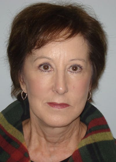 Facelift & Necklift Before & After Gallery - Patient 133024142 - Image 2