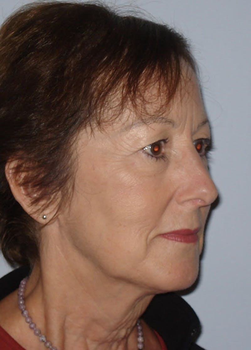 Facelift & Necklift Before & After Gallery - Patient 133024142 - Image 3