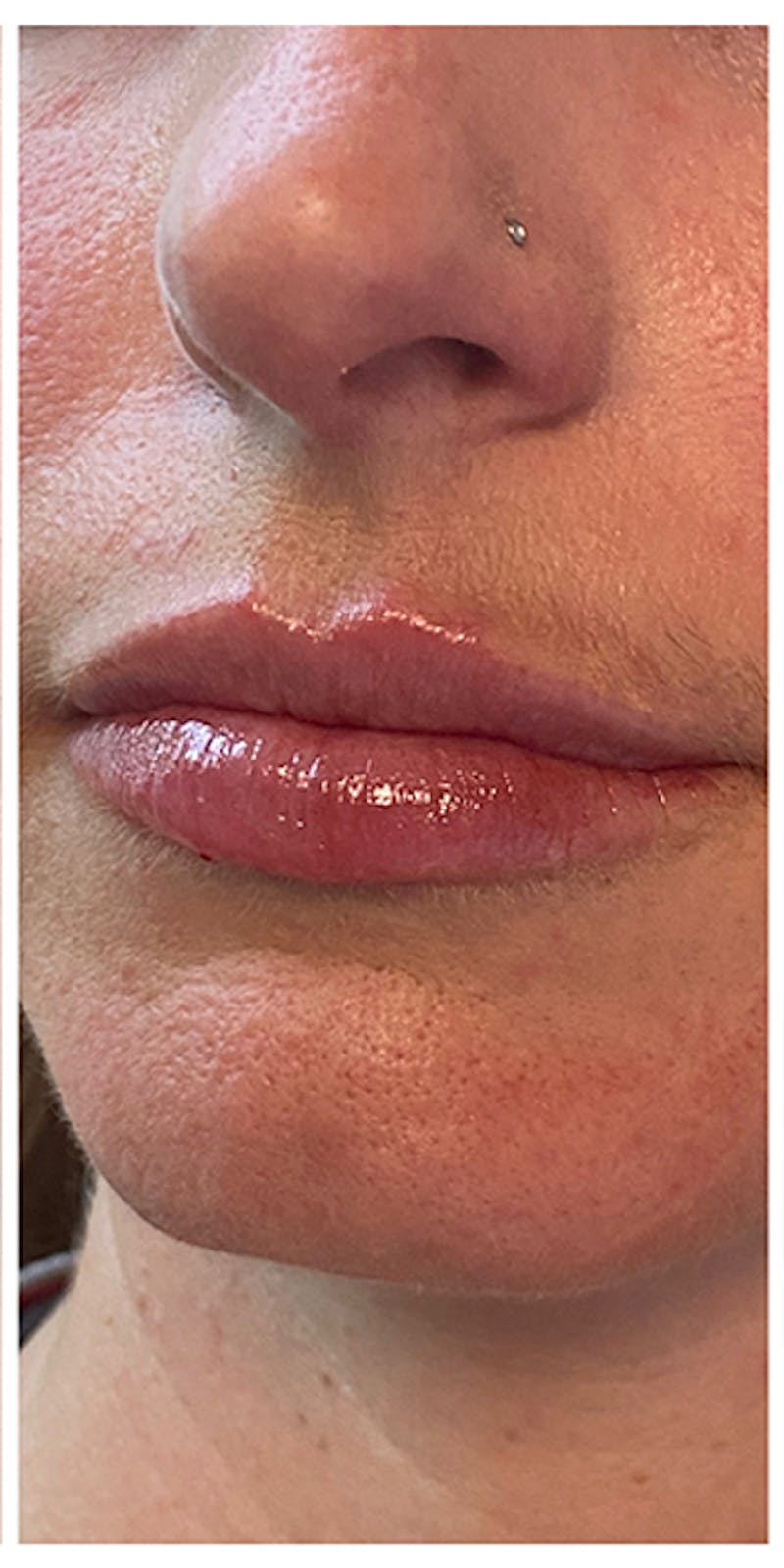 Lip Enhancement Before & After Gallery - Patient 133024141 - Image 8