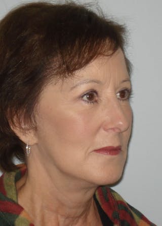 Facelift & Necklift Before & After Gallery - Patient 133024142 - Image 4