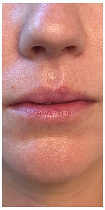 Lip Enhancement Before & After Gallery - Patient 133024143 - Image 1