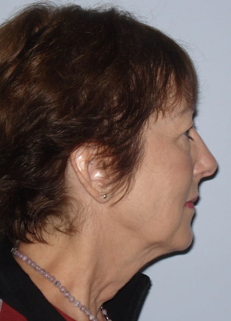 Facelift & Necklift Before & After Gallery - Patient 133024142 - Image 5
