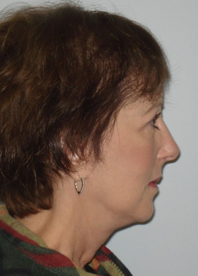 Facelift & Necklift Before & After Gallery - Patient 133024142 - Image 6