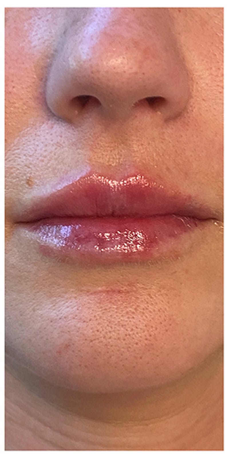 Lip Enhancement Before & After Gallery - Patient 133024143 - Image 2