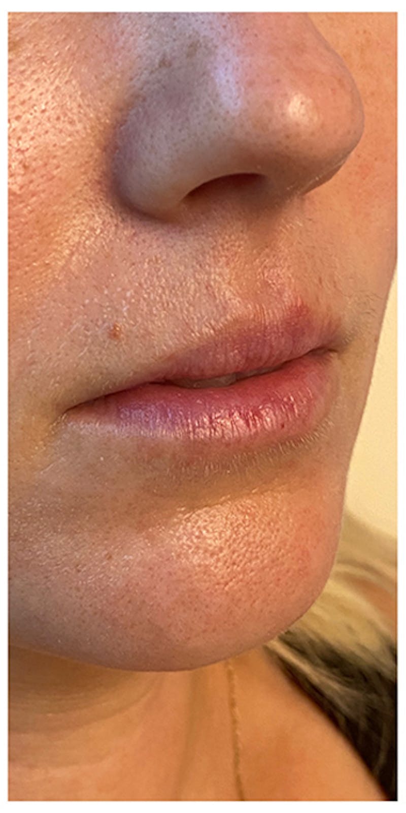 Lip Enhancement Before & After Gallery - Patient 133024143 - Image 3