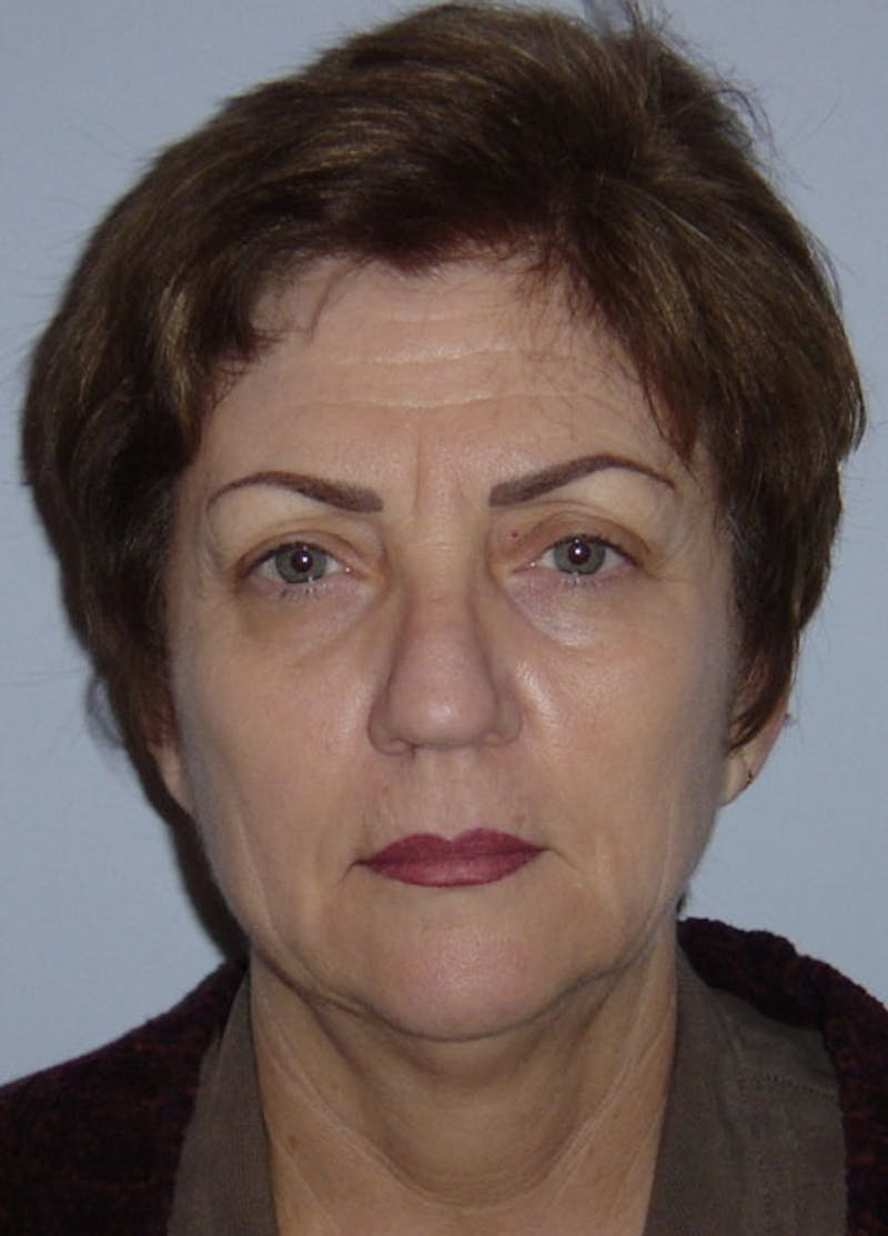 Facelift & Necklift Before & After Gallery - Patient 133024144 - Image 1