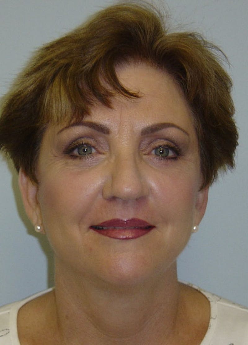 Facelift & Necklift Before & After Gallery - Patient 133024144 - Image 2