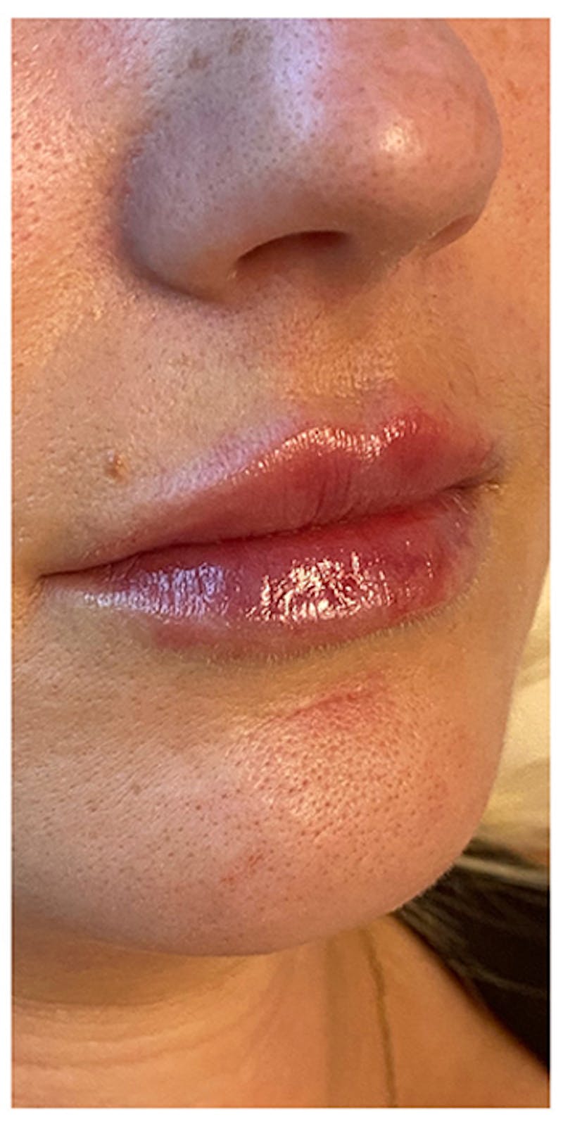 Lip Enhancement Before & After Gallery - Patient 133024143 - Image 4