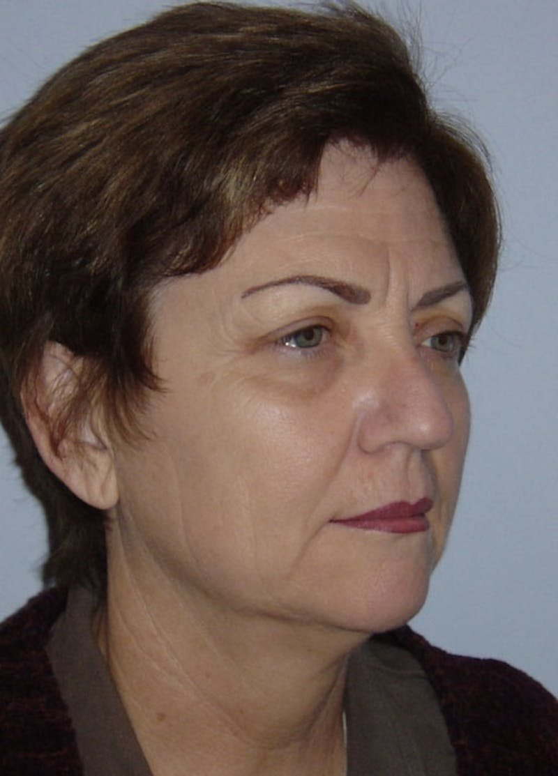 Facelift & Necklift Before & After Gallery - Patient 133024144 - Image 3
