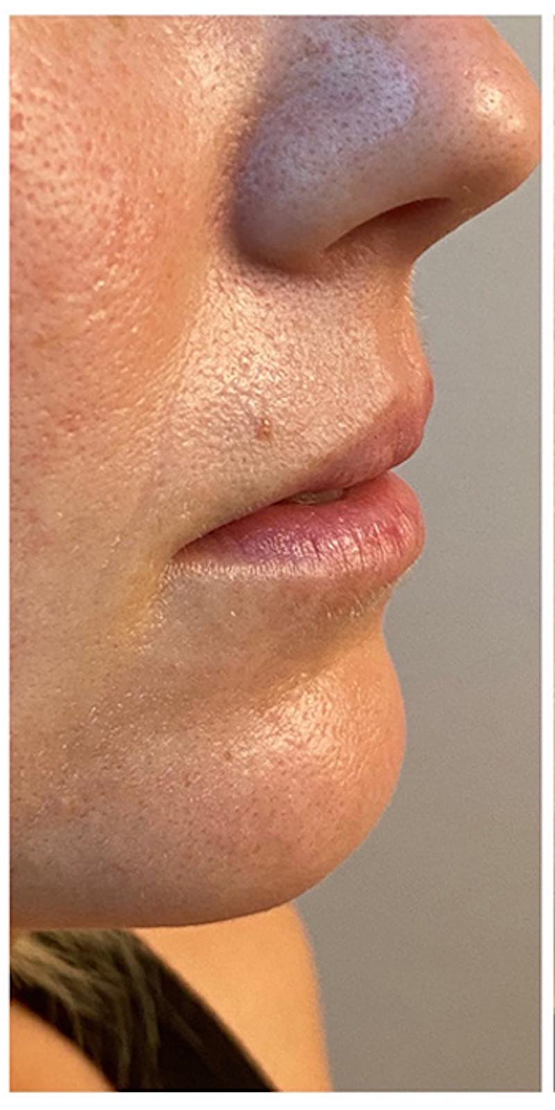Lip Enhancement Before & After Gallery - Patient 133024143 - Image 5