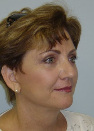 Facelift & Necklift Before & After Gallery - Patient 133024144 - Image 4