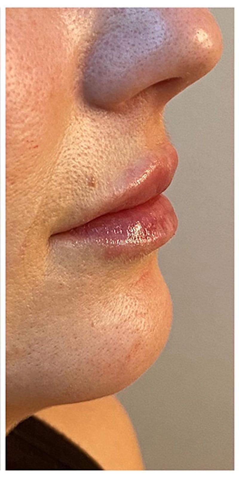 Lip Enhancement Before & After Gallery - Patient 133024143 - Image 6