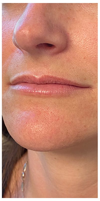 Lip Enhancement Before & After Gallery - Patient 133024152 - Image 1