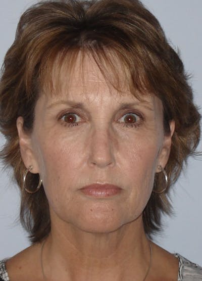 Facelift & Necklift Before & After Gallery - Patient 133024149 - Image 1