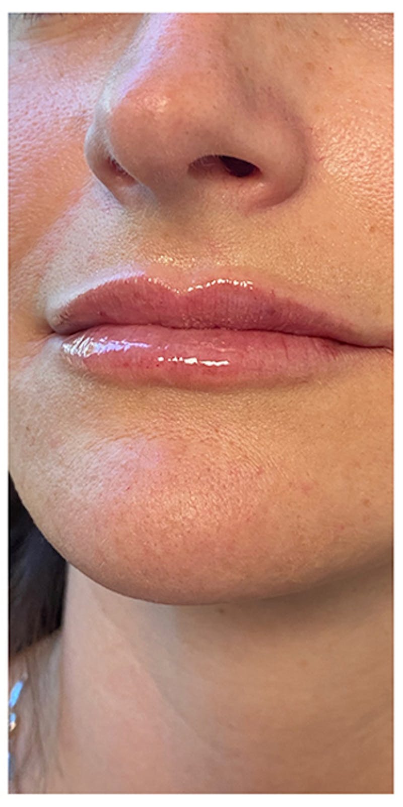 Lip Enhancement Before & After Gallery - Patient 133024152 - Image 2