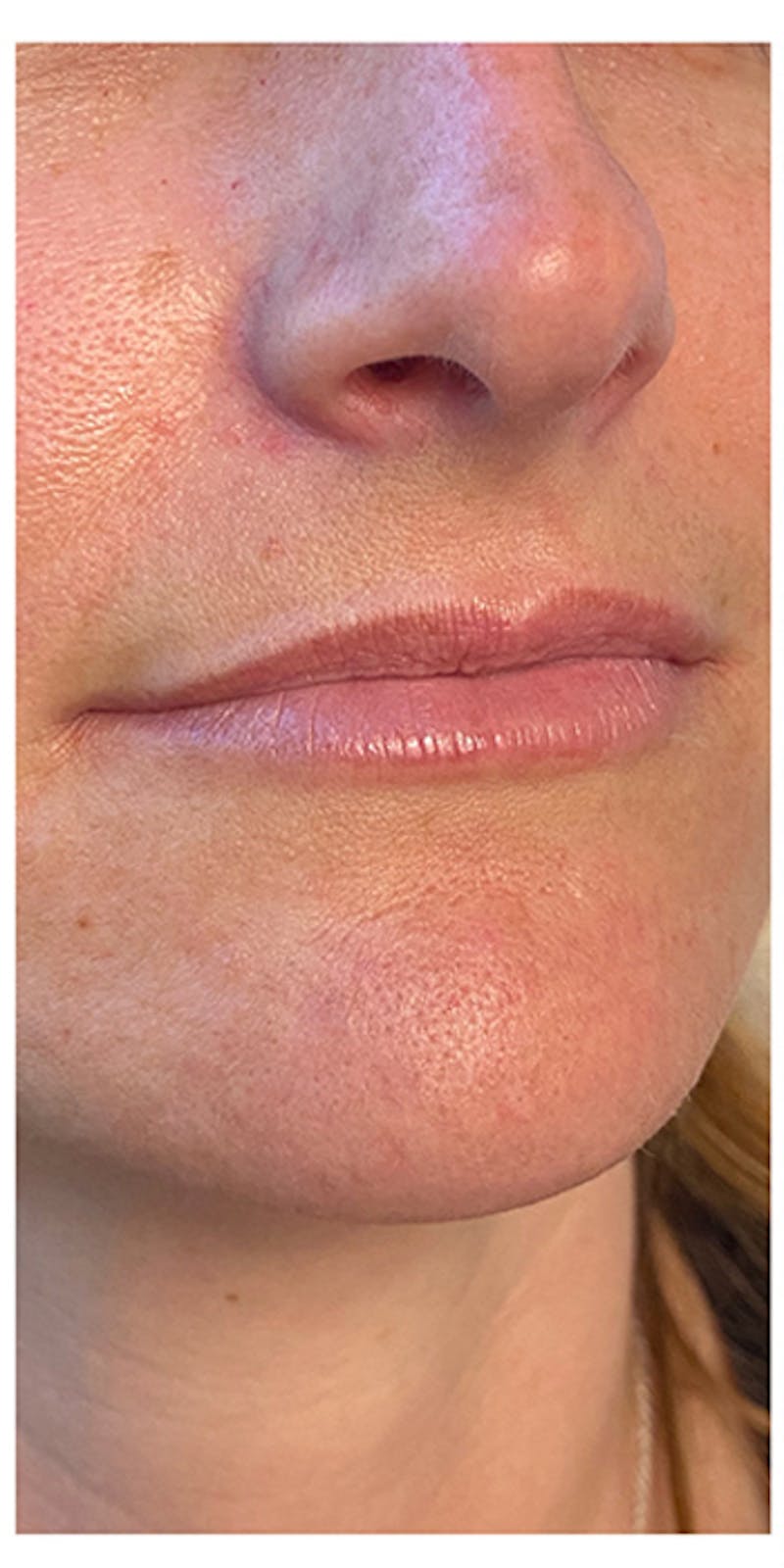 Lip Enhancement Before & After Gallery - Patient 133024152 - Image 3