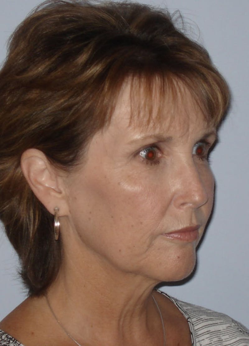 Facelift & Necklift Before & After Gallery - Patient 133024149 - Image 3