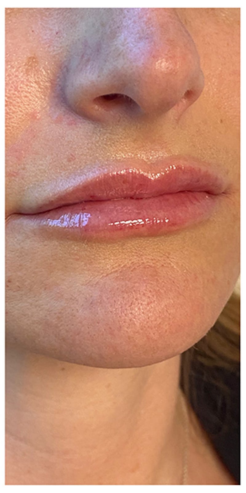 Lip Enhancement Before & After Gallery - Patient 133024152 - Image 4