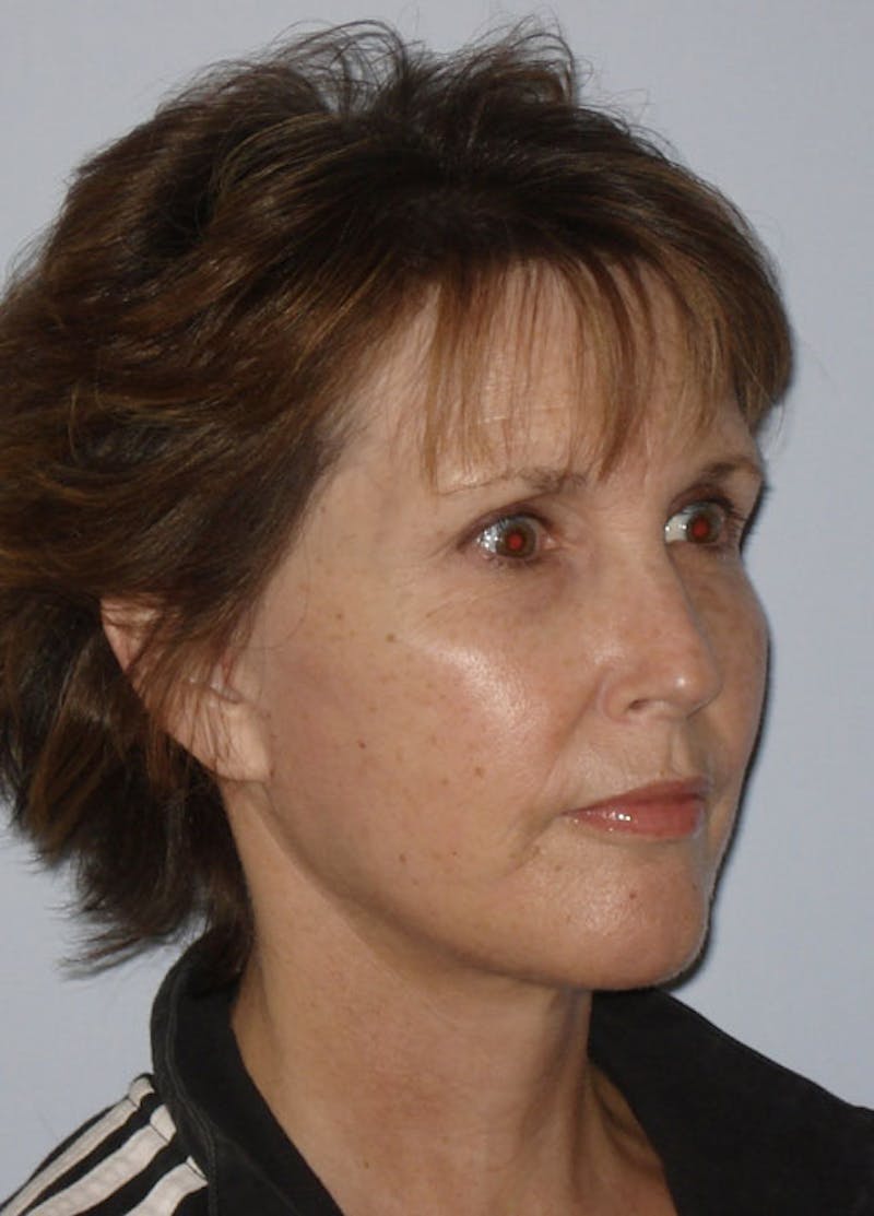 Facelift & Necklift Before & After Gallery - Patient 133024149 - Image 4