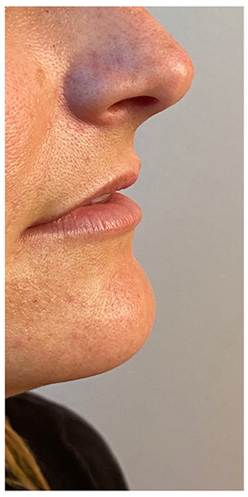 Lip Enhancement Before & After Gallery - Patient 133024152 - Image 5
