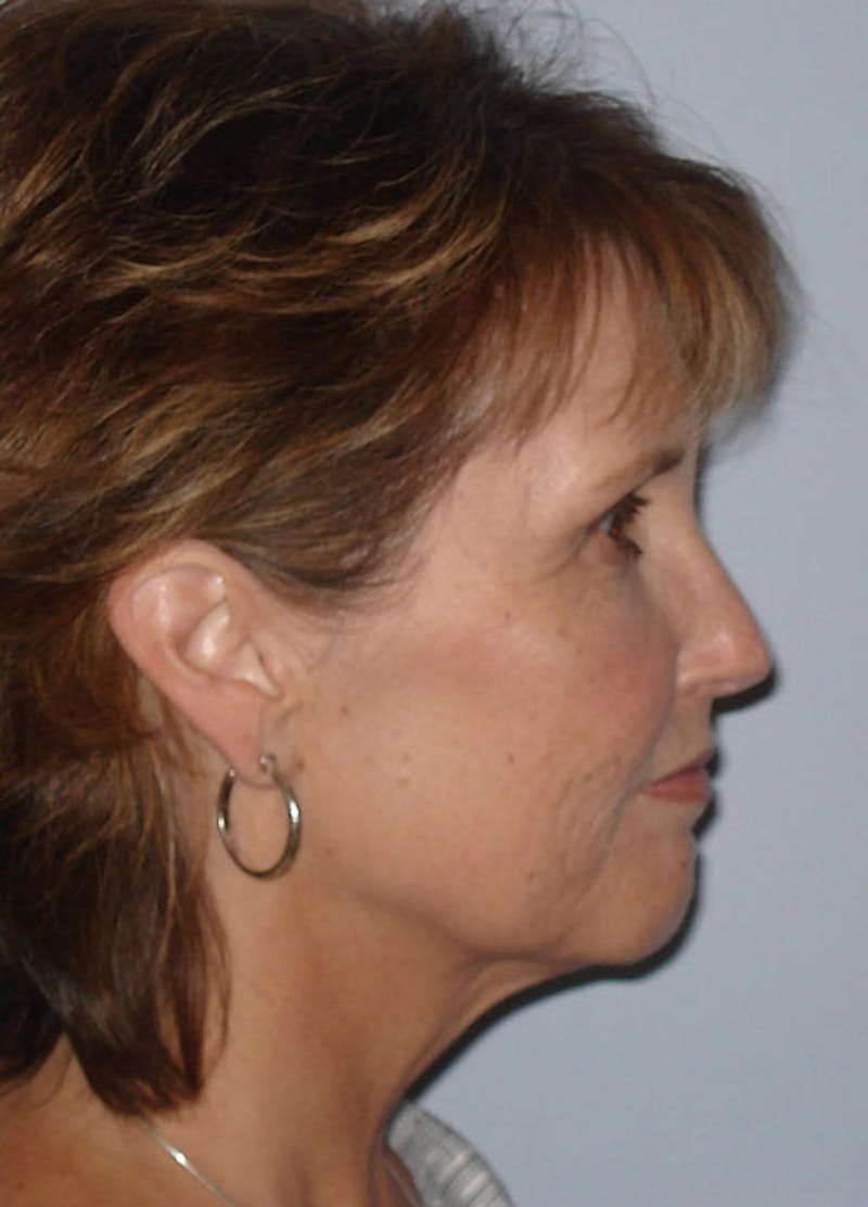 Facelift & Necklift Before & After Gallery - Patient 133024149 - Image 5