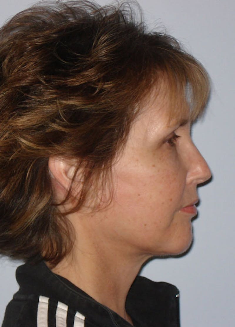 Facelift & Necklift Before & After Gallery - Patient 133024149 - Image 6