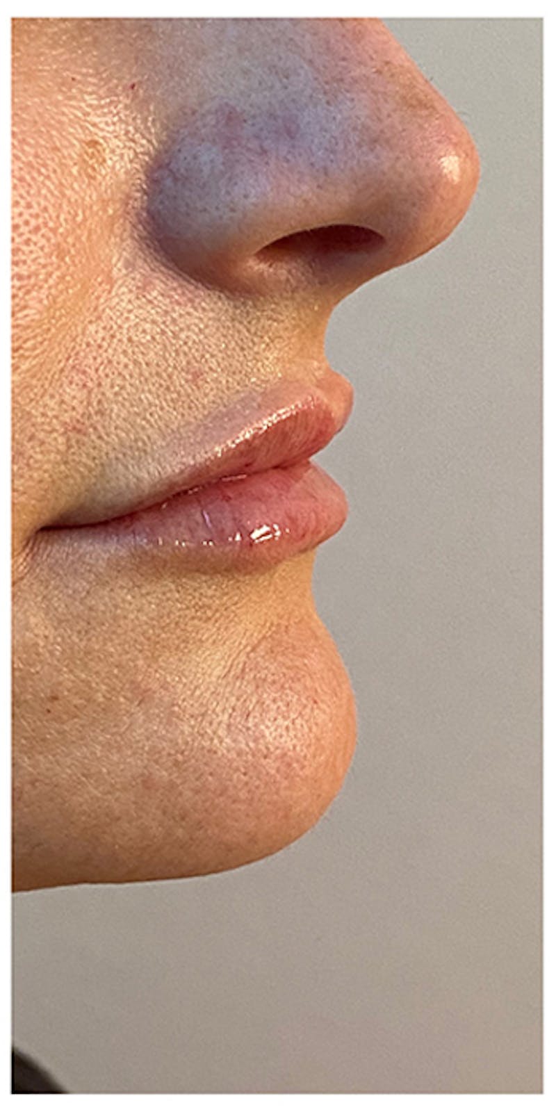 Lip Enhancement Before & After Gallery - Patient 133024152 - Image 6