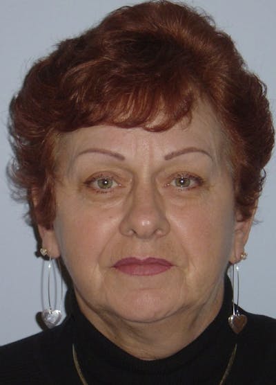 Facelift & Necklift Before & After Gallery - Patient 133024154 - Image 1