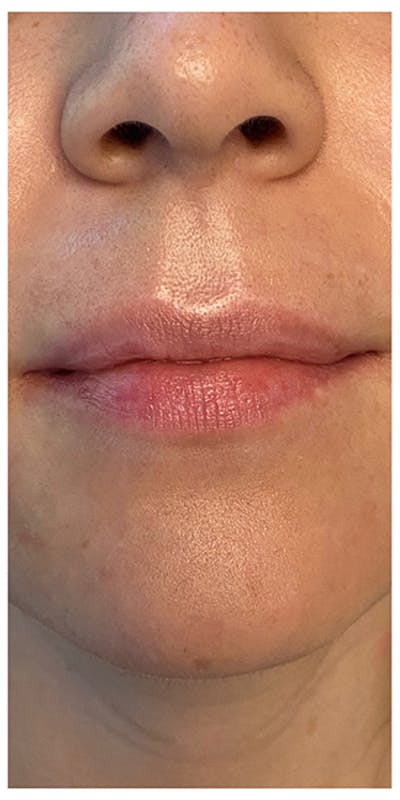 Lip Enhancement Before & After Gallery - Patient 133024158 - Image 1