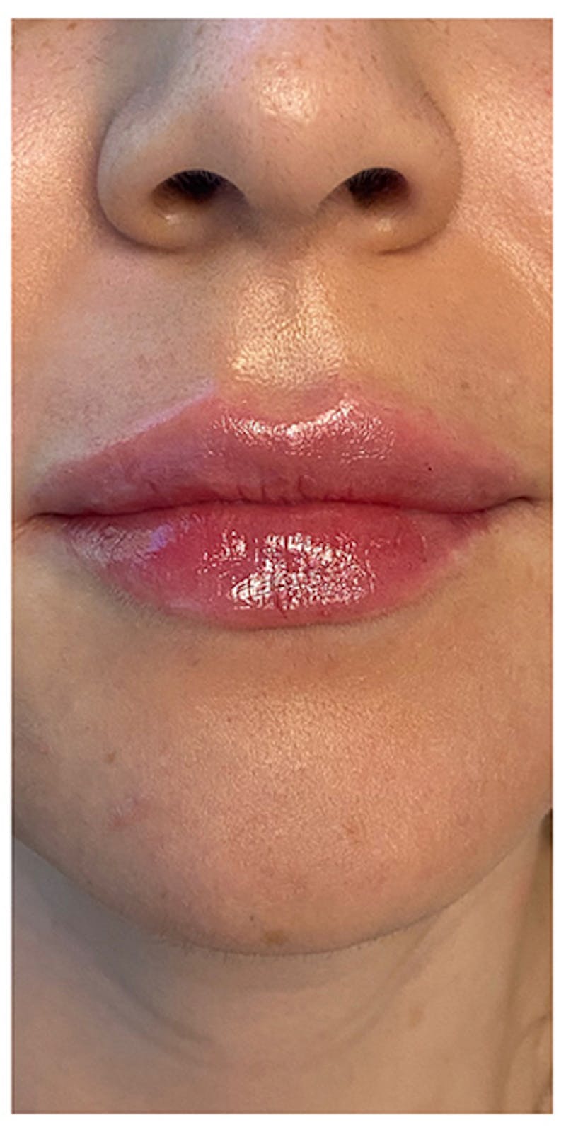 Lip Enhancement Before & After Gallery - Patient 133024158 - Image 2