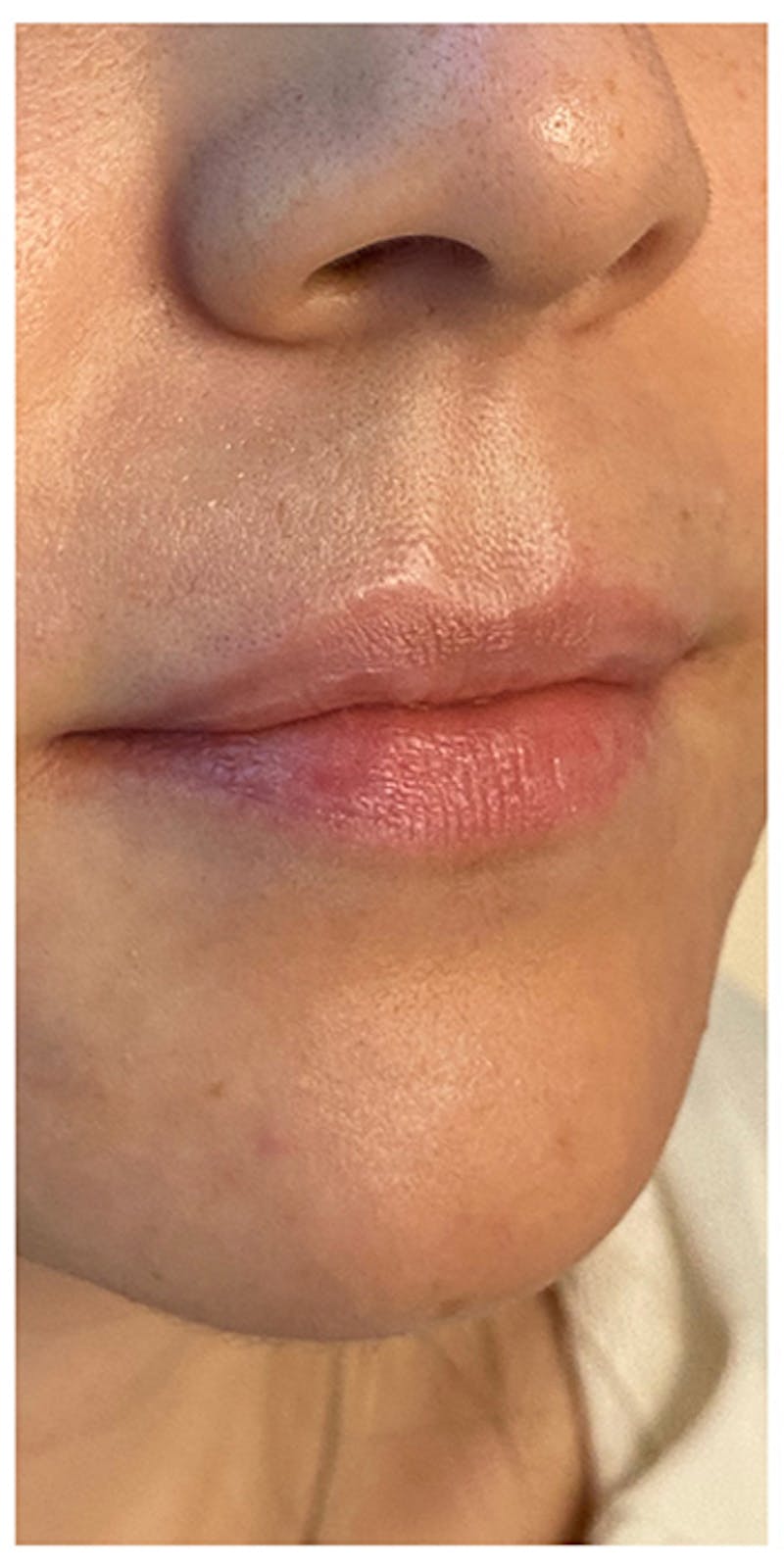 Lip Enhancement Before & After Gallery - Patient 133024158 - Image 3