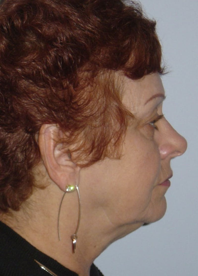 Facelift & Necklift Before & After Gallery - Patient 133024154 - Image 5