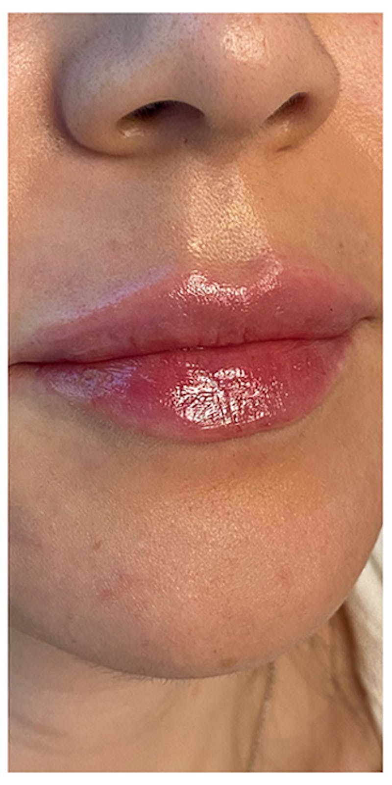 Lip Enhancement Before & After Gallery - Patient 133024158 - Image 4