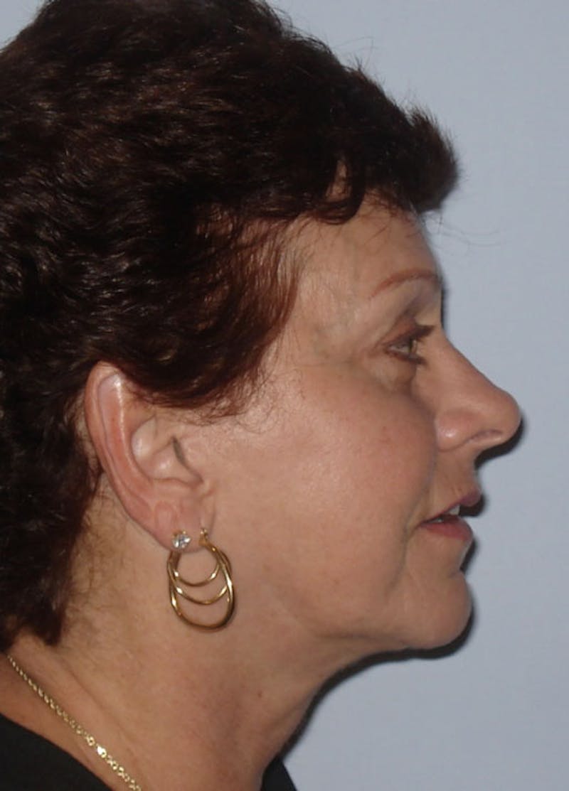 Facelift & Necklift Before & After Gallery - Patient 133024154 - Image 6