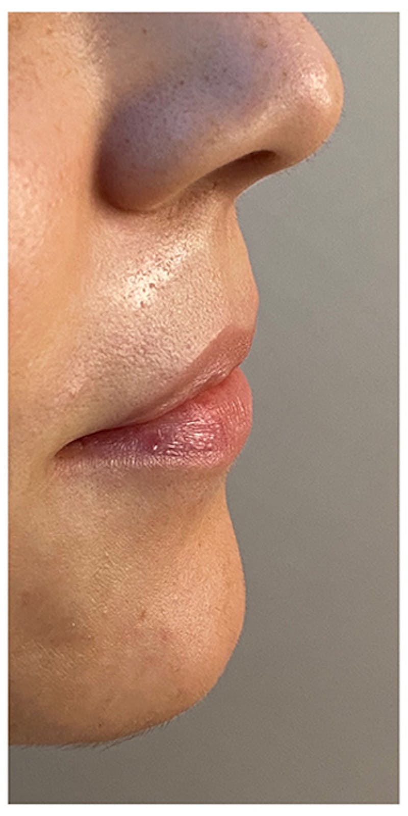 Lip Enhancement Before & After Gallery - Patient 133024158 - Image 5
