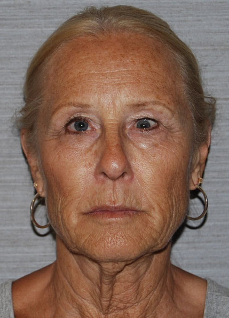 Facelift & Necklift Before & After Gallery - Patient 133024159 - Image 1