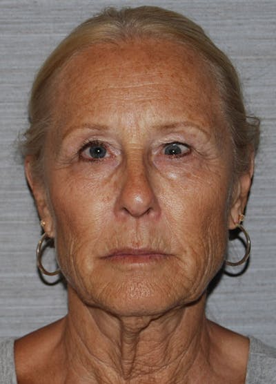 Facelift & Necklift Before & After Gallery - Patient 133024159 - Image 1