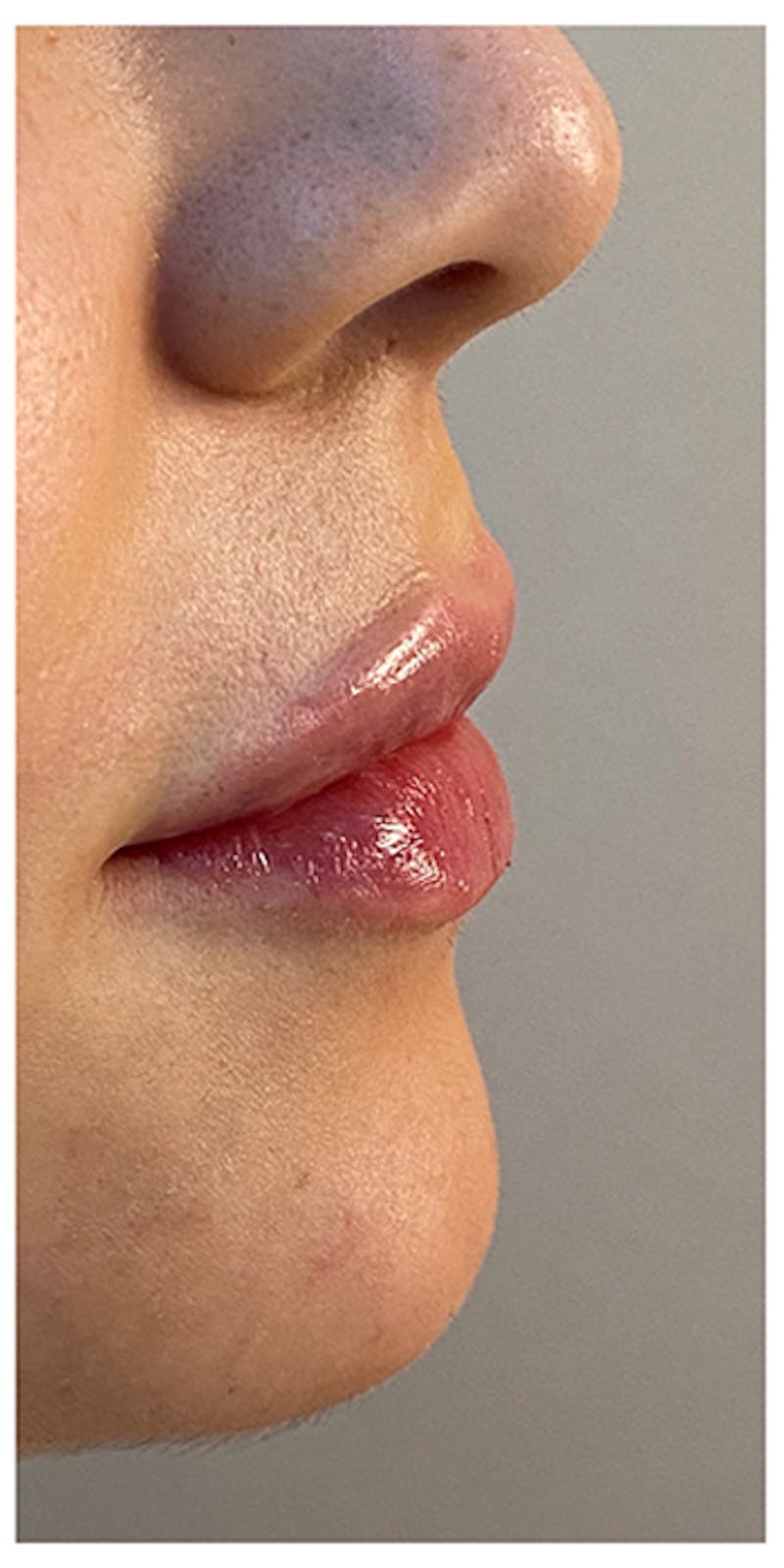 Lip Enhancement Before & After Gallery - Patient 133024158 - Image 6