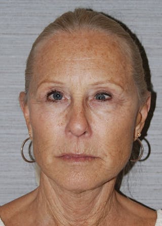 Facelift & Necklift Before & After Gallery - Patient 133024159 - Image 2