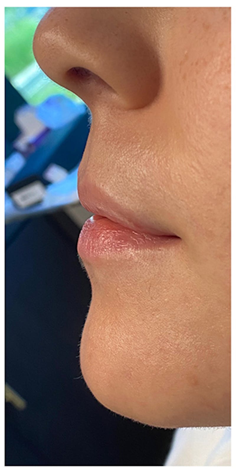 Lip Enhancement Before & After Gallery - Patient 133024158 - Image 7