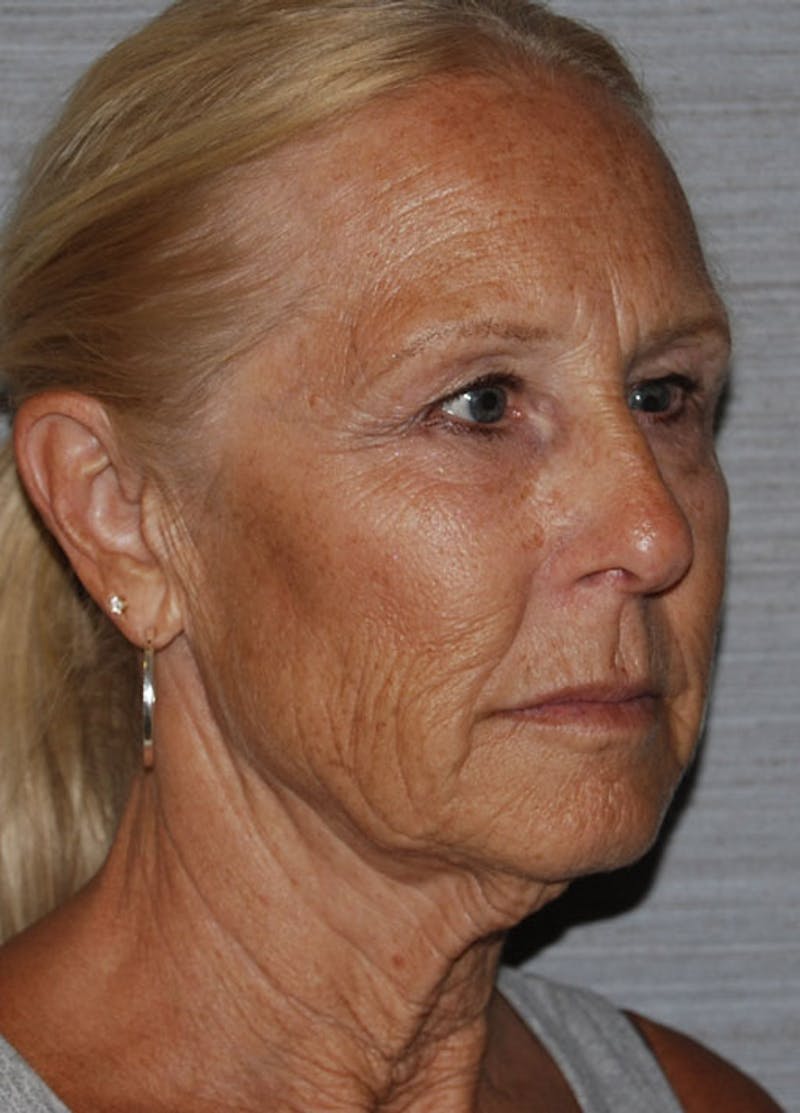 Facelift & Necklift Before & After Gallery - Patient 133024159 - Image 3