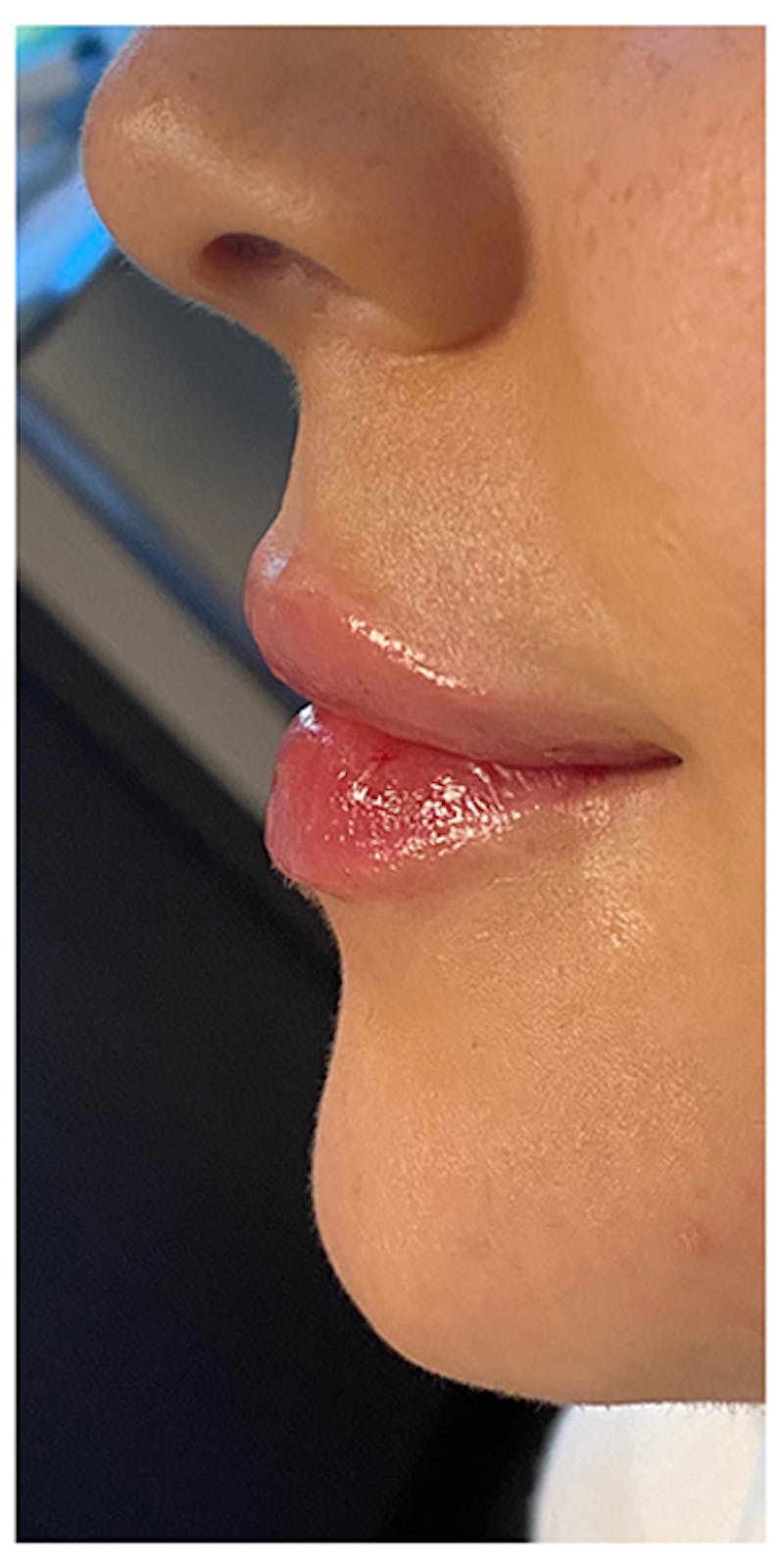 Lip Enhancement Before & After Gallery - Patient 133024158 - Image 8