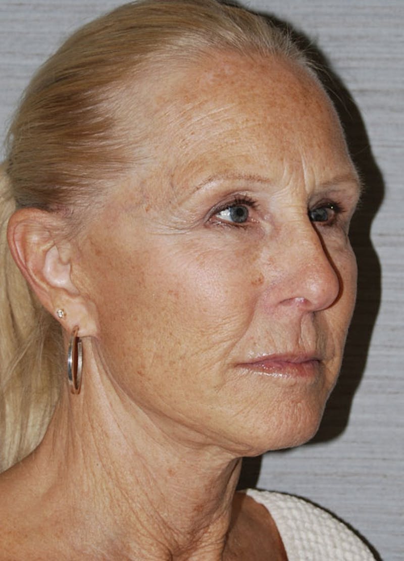 Facelift & Necklift Before & After Gallery - Patient 133024159 - Image 4