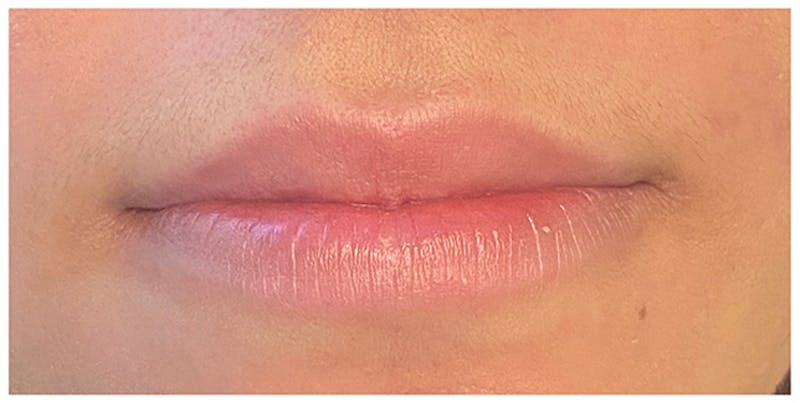Lip Enhancement Before & After Gallery - Patient 133024162 - Image 1