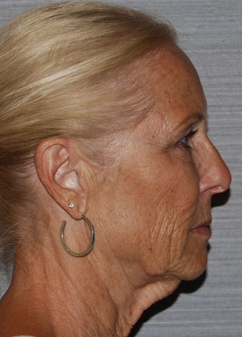 Facelift & Necklift Before & After Gallery - Patient 133024159 - Image 5