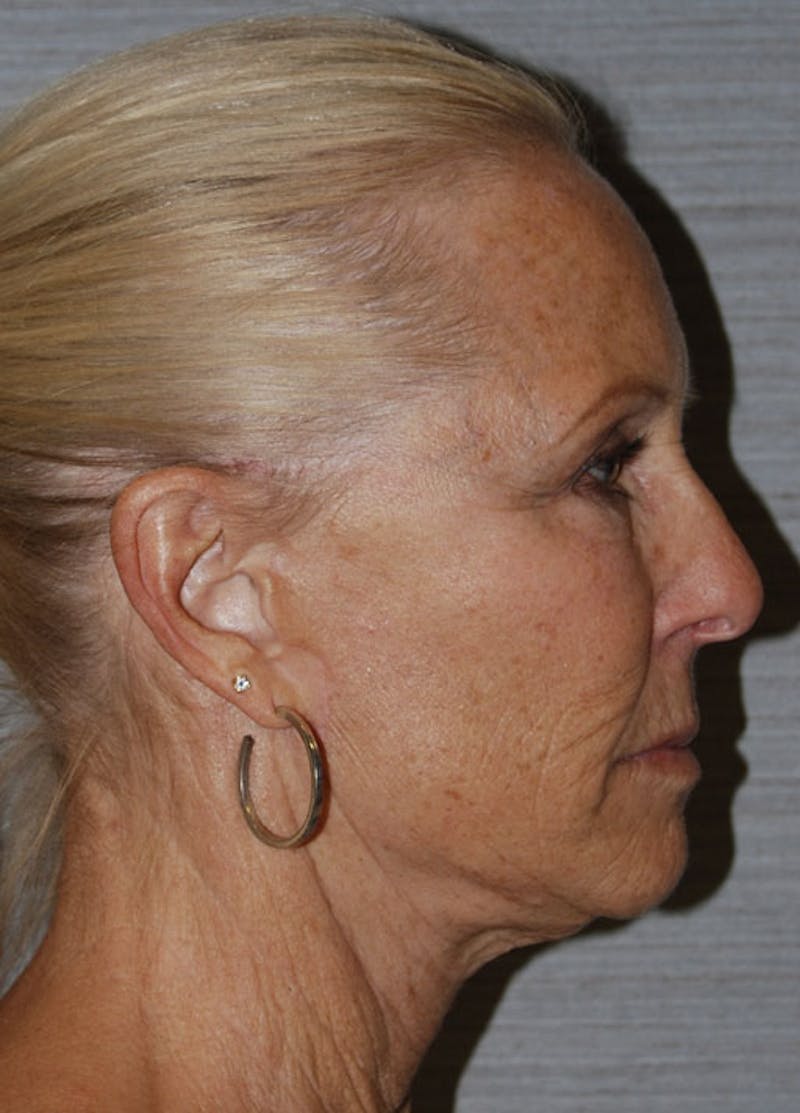Facelift & Necklift Before & After Gallery - Patient 133024159 - Image 6