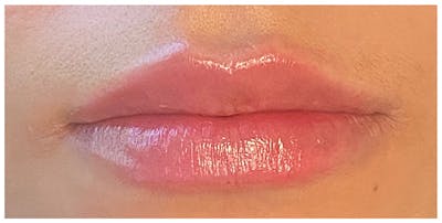 Lip Enhancement Before & After Gallery - Patient 133024162 - Image 2