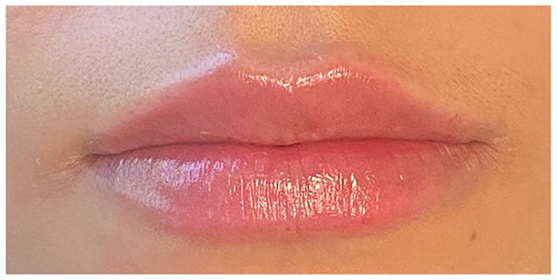 Lip Enhancement Before & After Gallery - Patient 133024162 - Image 2